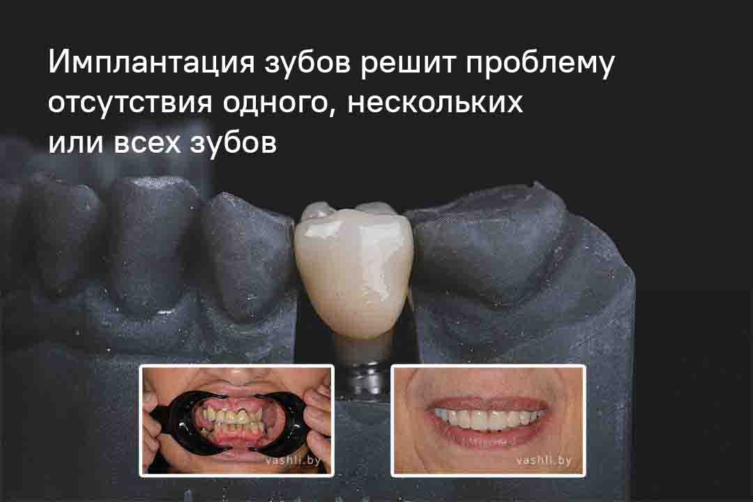 Имплантация зубов в Симферополе