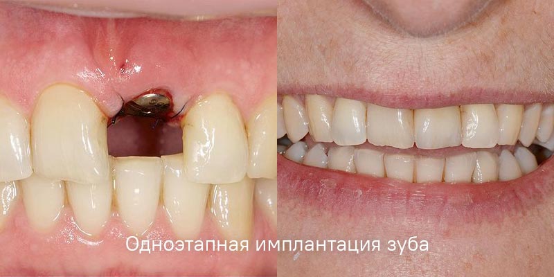 Одноэтапная имплантация зубов
