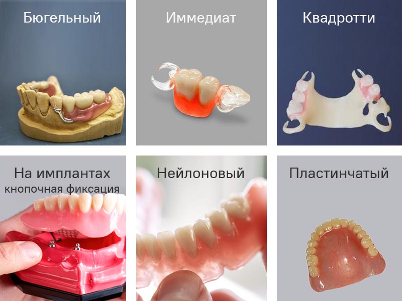 Особенности и виды протезирования передних зубов